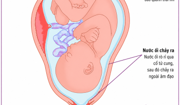 ỐI VỠ NON VÀ CÁCH XỬ TRÍ